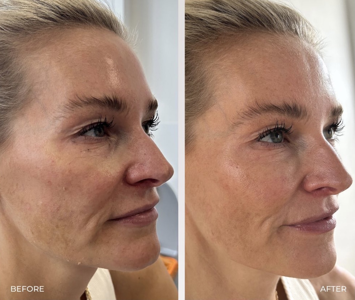 MorySkin zeigt philart – Exklusive Filler für Ihre Schönheit