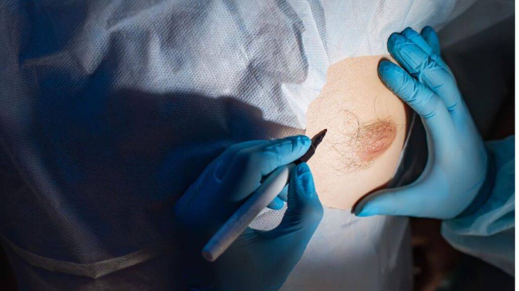 Nachhaltige Ergebnisse mit der Brustvergrößerung mit Eigenfett